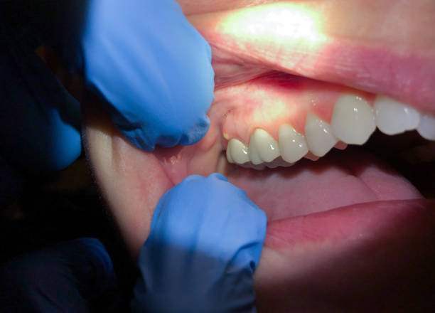 Best Emergency Treatment for Oral Infections in Chesterbrook, PA